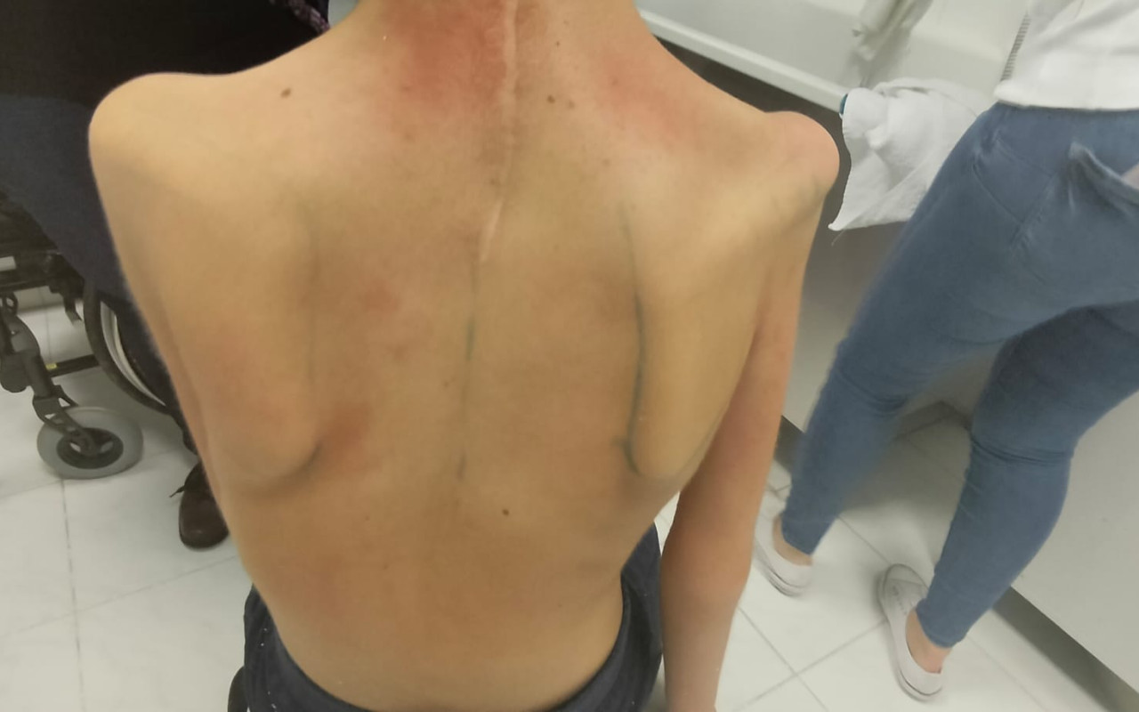 Složili jste se na unikátní ortézu na rameno pro Sárinku