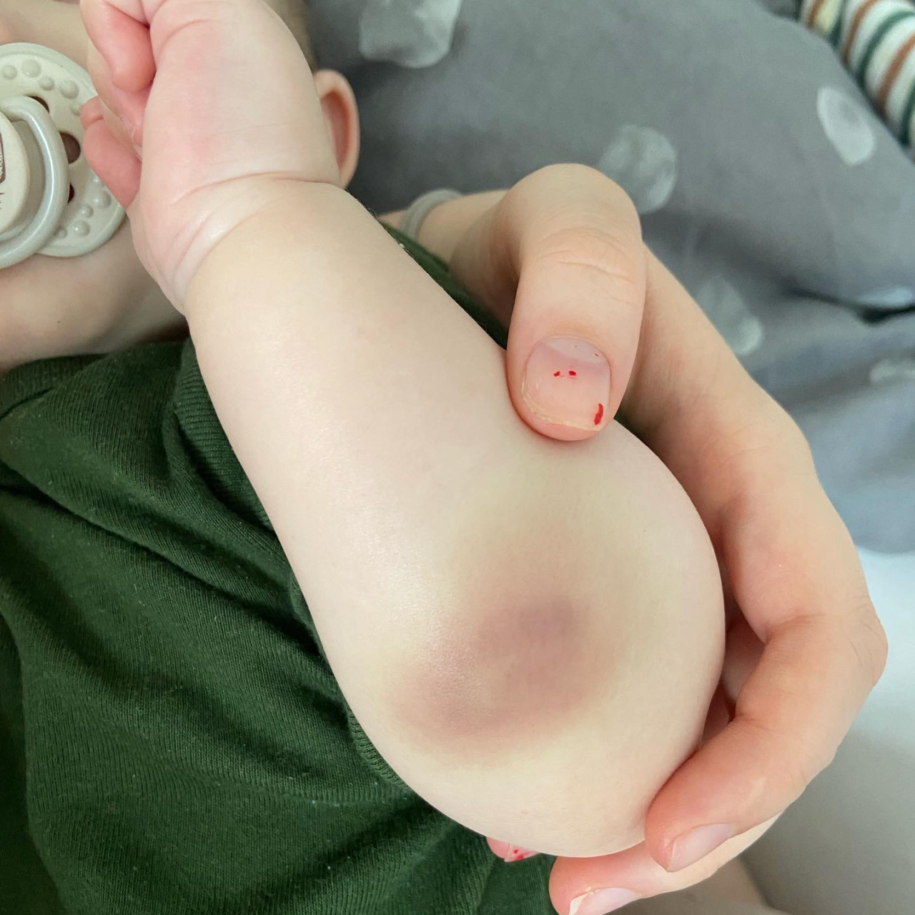 Pomohli jste Theodorkovi s těžkou formou HEMOFILIE typu A