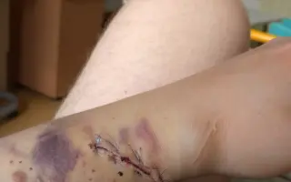 Pomoc s transplantací ledviny – šance na delší život