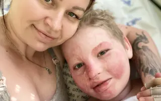 Šance pro Tondu na zotavení po vážných popáleninách