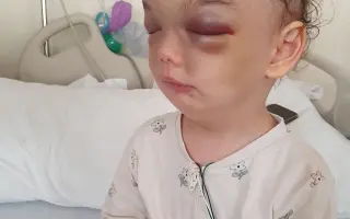 Izinka, operace v USA // Izinka's surgery in the USA