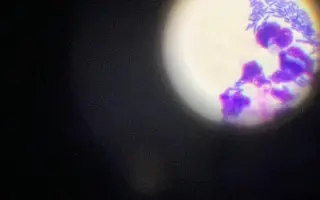 Pomoc Furině v boji s lupusem (SLE)