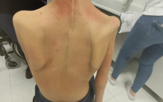 Sárinka - unikátní ortéza na rameno, následky po operaci nádoru krční míchy