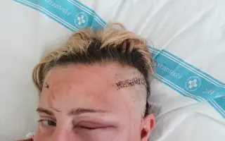 Pomoc Lucii s tumorem mozku