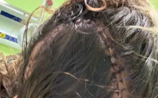 Lékařka Alča dál bojuje s glioblastomem - další šance na život