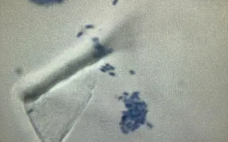 Pomoc Furině v boji s lupusem (SLE)