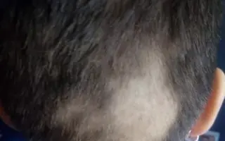 Nele na nové zuby