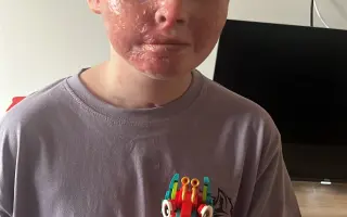 Šance pro Tondu na zotavení po vážných popáleninách