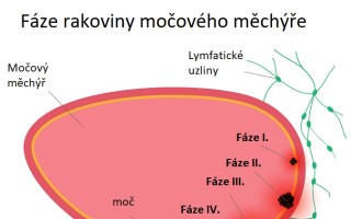 Prosím o moderní léčbu - aby našich 5 dětí nemělo mámu s vývodem