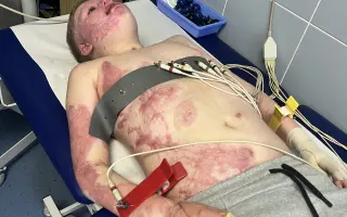 Šance pro Tondu na zotavení po vážných popáleninách