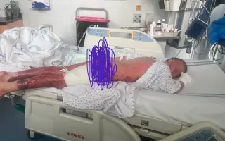 Šance pro Tondu na zotavení po vážných popáleninách