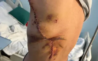 Po rakovině přišla o oko, pomozme jí zlepšit život