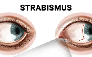 Vyšetření strabismu