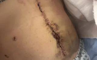 Naděje pro důstojný život s nevyléčitelnou nemocí MEN1