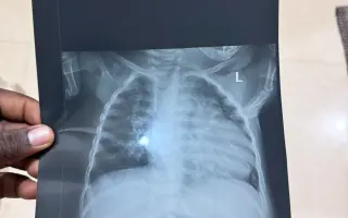 ❤️🙏 Pomoc pro malou Ayram z Ugandy s onemocněním plicní atrézie VSD