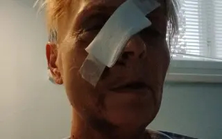 Po rakovině přišla o oko, pomozme jí zlepšit život
