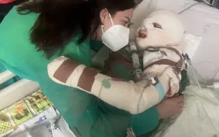 Šance pro Tondu na zotavení po vážných popáleninách