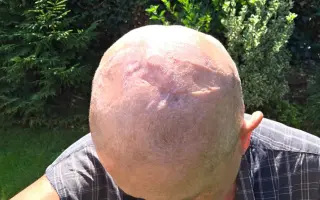Pomozme Lence porazit nádor mozku