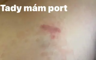 Podpora pro Věru a Natálku při léčbě závažné nemoci