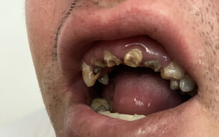 Nové zuby pro mladého tatínka dvojčat bojujícího s rakovinou