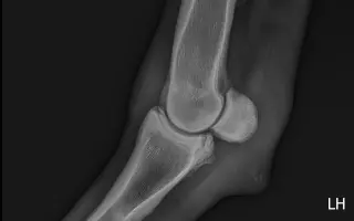 Valášek Artuš z Bezdědic - léčba a rehabilitace zlomeniny