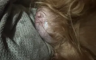 Operace nádoru pro Shany