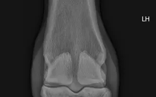 Valášek Artuš z Bezdědic - léčba a rehabilitace zlomeniny