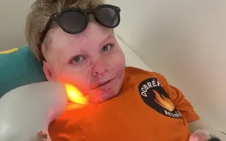 Šance pro Tondu na zotavení po vážných popáleninách