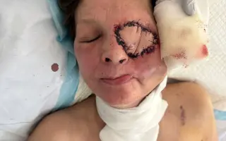 Po rakovině přišla o oko, pomozme jí zlepšit život