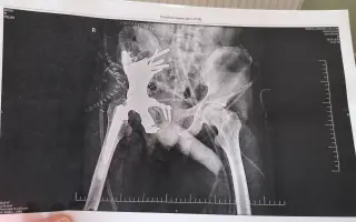 Rehabilitace a finanční pomoc při rakovině kostí ve 4. stádiu