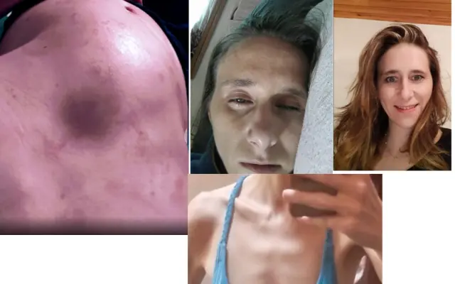 Kačka bojuje o život – šanci jí dává operace střev